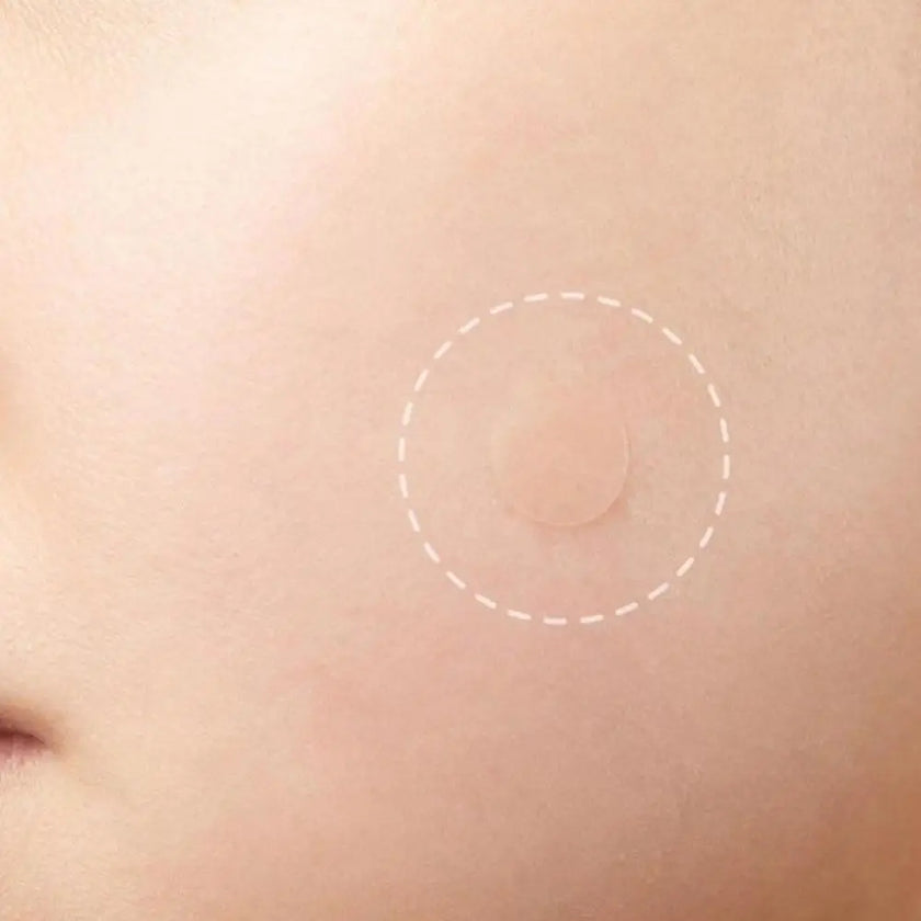 ClearSkin Hydrocolloid Acne Patches – Invisible & Healing